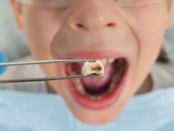 Best Emergency Tooth Extraction in Springfield, CO