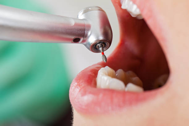 Best Emergency Treatment for Toothache in Springfield, CO